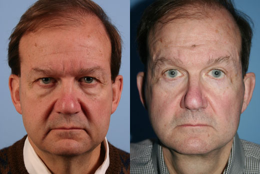 Eyelid Surgery before and after photo by Midwest Facial Plastic Surgery in Minnesota