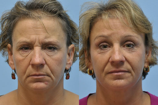 Eyelid Surgery before and after photo by Midwest Facial Plastic Surgery in Minnesota