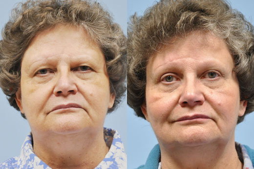 Eyelid Surgery before and after photo by Midwest Facial Plastic Surgery in Minnesota