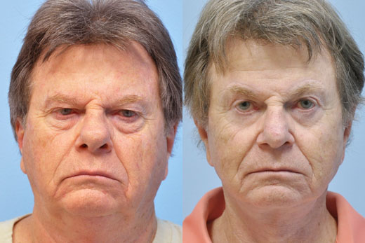 Eyelid Surgery before and after photo by Midwest Facial Plastic Surgery in Minnesota