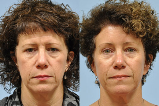 Eyelid Surgery before and after photo by Midwest Facial Plastic Surgery in Minnesota