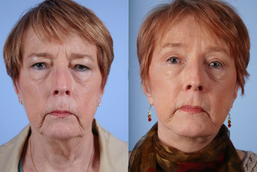 Eyelid Surgery before and after photo by Midwest Facial Plastic Surgery in Minnesota