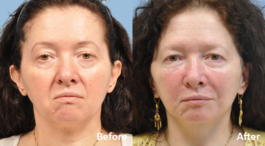 Facelift before and after photo by Midwest Facial Plastic Surgery in Minnesota