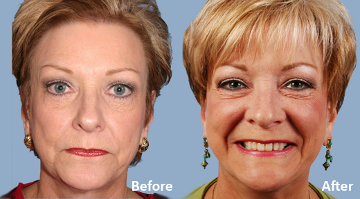 Facelift before and after photo by Midwest Facial Plastic Surgery in Minnesota