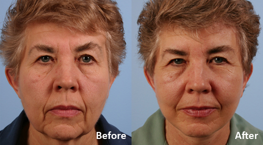 Facelift before and after photo by Midwest Facial Plastic Surgery in Minnesota