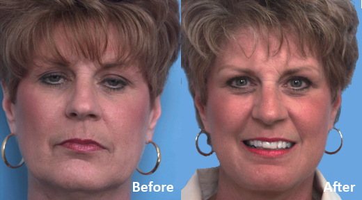 Facelift before and after photo by Midwest Facial Plastic Surgery in Minnesota