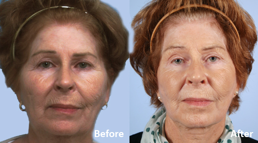 Facelift before and after photo by Midwest Facial Plastic Surgery in Minnesota