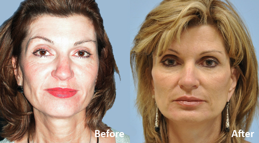 Facelift before and after photo by Midwest Facial Plastic Surgery in Minnesota