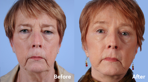 Facelift before and after photo by Midwest Facial Plastic Surgery in Minnesota