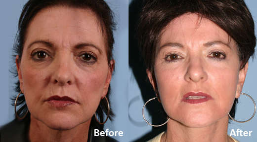 Facelift before and after photo by Midwest Facial Plastic Surgery in Minnesota
