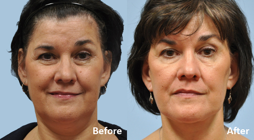 Facelift before and after photo by Midwest Facial Plastic Surgery in Minnesota