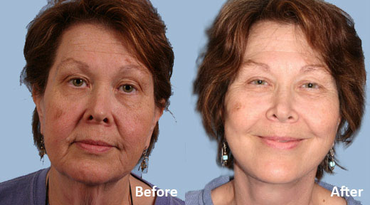 Facelift before and after photo by Midwest Facial Plastic Surgery in Minnesota