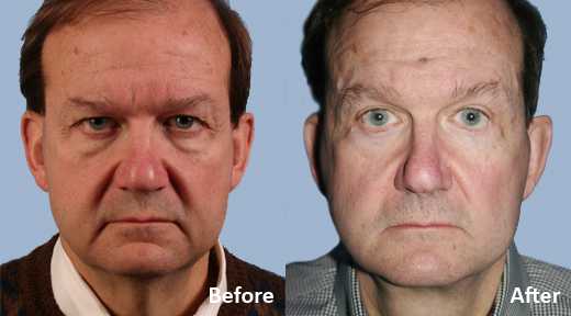 Facelift before and after photo by Midwest Facial Plastic Surgery in Minnesota