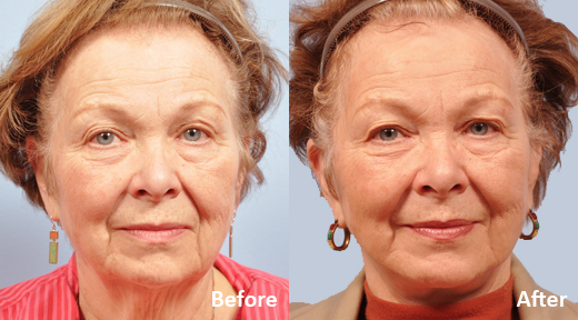 Facelift before and after photo by Midwest Facial Plastic Surgery in Minnesota