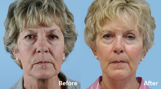 Facelift before and after photo by Midwest Facial Plastic Surgery in Minnesota