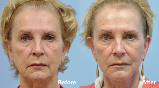 Facelift before and after photo by Midwest Facial Plastic Surgery in Minnesota