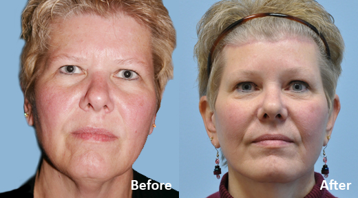 Facelift before and after photo by Midwest Facial Plastic Surgery in Minnesota