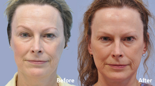 Facelift before and after photo by Midwest Facial Plastic Surgery in Minnesota