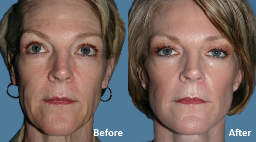 Facelift before and after photo by Midwest Facial Plastic Surgery in Minnesota