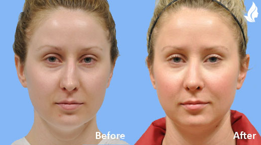 Rhinoplasty before and after photo by Midwest Facial Plastic Surgery in Minnesota