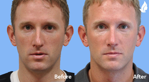 Rhinoplasty before and after photo by Midwest Facial Plastic Surgery in Minnesota