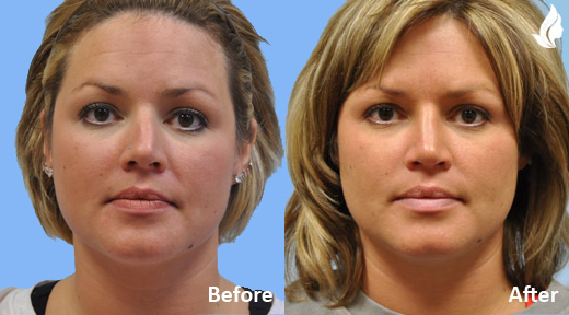 Rhinoplasty before and after photo by Midwest Facial Plastic Surgery in Minnesota