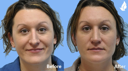 Rhinoplasty before and after photo by Midwest Facial Plastic Surgery in Minnesota
