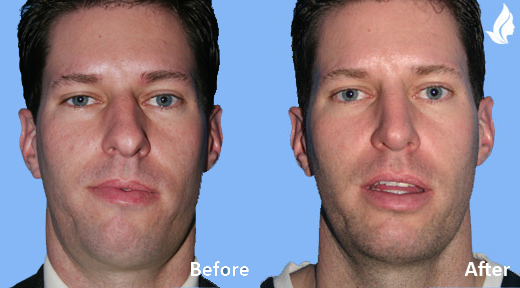 Rhinoplasty before and after photo by Midwest Facial Plastic Surgery in Minnesota