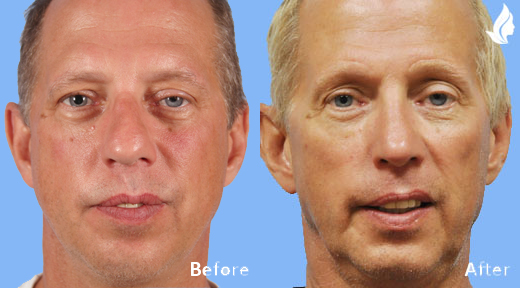 Rhinoplasty before and after photo by Midwest Facial Plastic Surgery in Minnesota