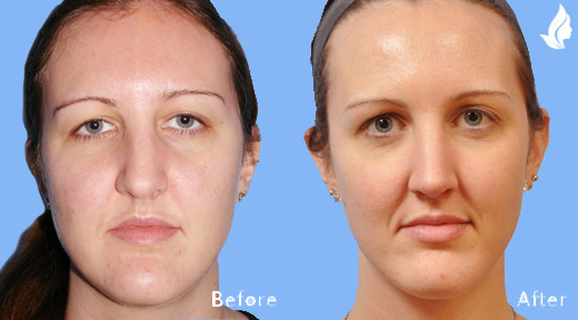 Rhinoplasty before and after photo by Midwest Facial Plastic Surgery in Minnesota