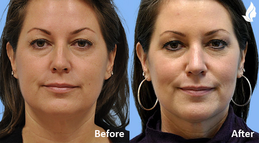 Rhinoplasty before and after photo by Midwest Facial Plastic Surgery in Minnesota