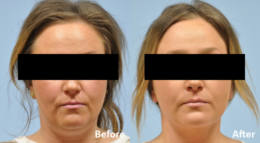 Neck Lift before and after photo by Midwest Facial Plastic Surgery in Minnesota