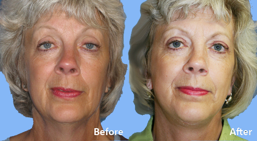 Neck Lift before and after photo by Midwest Facial Plastic Surgery in Minnesota