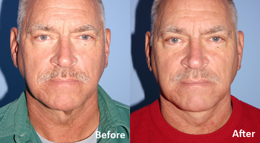 Neck Lift before and after photo by Midwest Facial Plastic Surgery in Minnesota