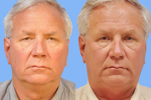 Eyelid Surgery before and after photo by Midwest Facial Plastic Surgery in Minnesota