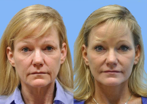 Facelift before and after photo by Midwest Facial Plastic Surgery in Minnesota