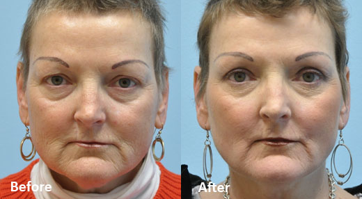 Laser Skin Resurfacing before and after photo by Midwest Facial Plastic Surgery in Minnesota