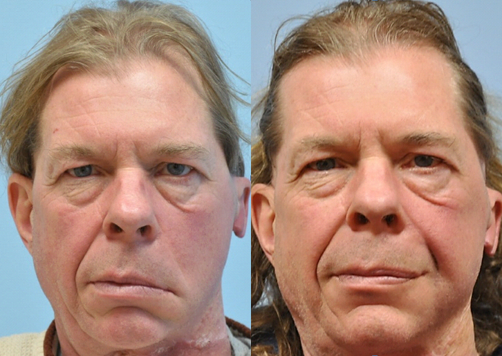 Facial Paralysis before and after photo by Midwest Facial Plastic Surgery in Minnesota