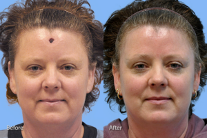 Mohs Reconstruction before and after photo by Midwest Facial Plastic Surgery in Minnesota