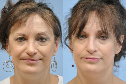 Lip Augmentation before and after photo by Midwest Facial Plastic Surgery in Minnesota