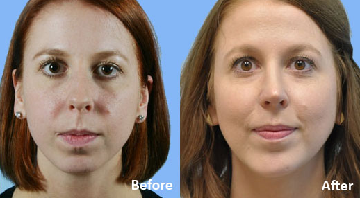 Facial Implants Chin Augmentation before and after photo by Midwest Facial Plastic Surgery in Minnesota