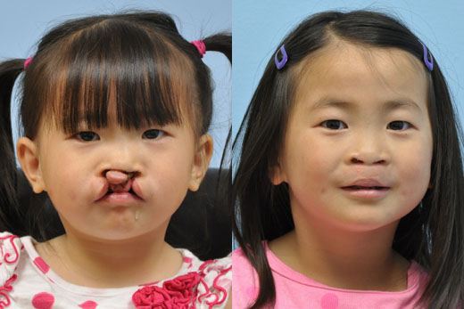 Cleft Lip Nose before and after photo by Midwest Facial Plastic Surgery in Minnesota