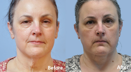 Neck Lift before and after photo by Midwest Facial Plastic Surgery in Minnesota