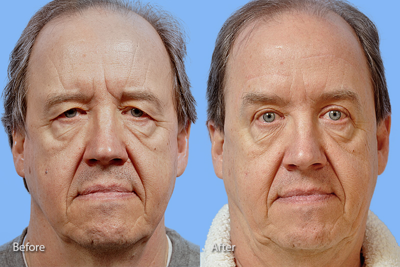 Eyelid Surgery before and after photo by Midwest Facial Plastic Surgery in Minnesota