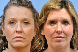 Injectable Fillers before and after photo by Midwest Facial Plastic Surgery in Minnesota