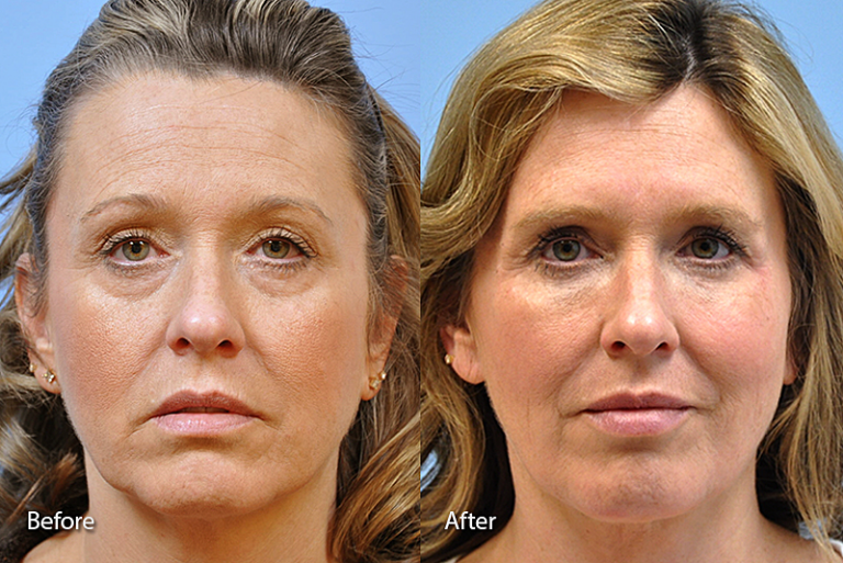 Before & After Galleries Midwest Facial Plastic Surgery