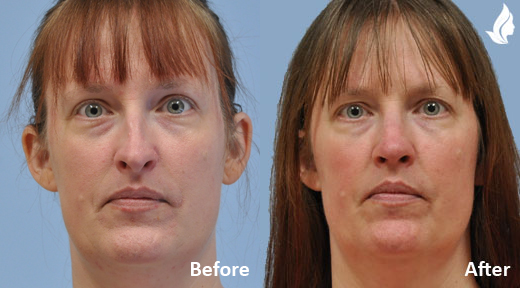 Rhinoplasty before and after photo by Midwest Facial Plastic Surgery in Minnesota