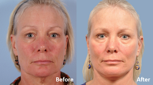 Facelift before and after photo by Midwest Facial Plastic Surgery in Minnesota