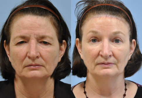 Eyelid Surgery before and after photo by Midwest Facial Plastic Surgery in Minnesota