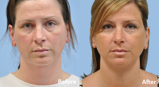 Neck Lift before and after photo by Midwest Facial Plastic Surgery in Minnesota Neck Lift before and after photo by Midwest Facial Plastic Surgery in Minnesota